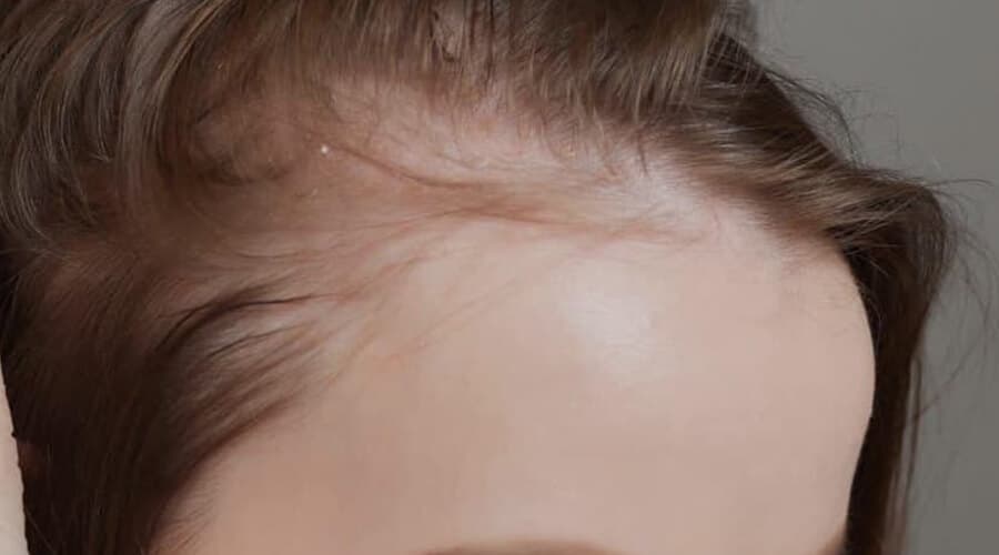 Alopecia (calvicie, caída excesiva de cabello)