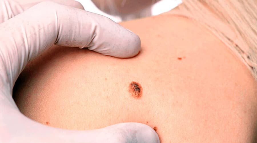 Cáncer de Piel