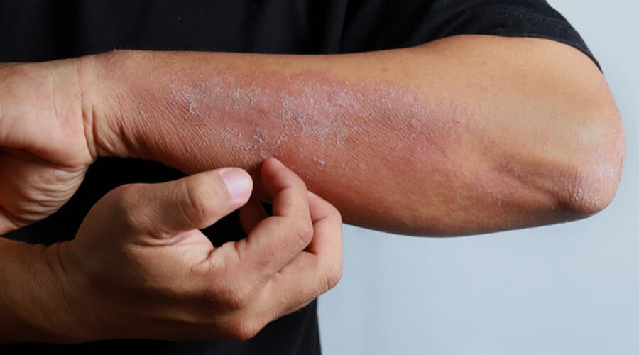 Dermatitis Atópica
