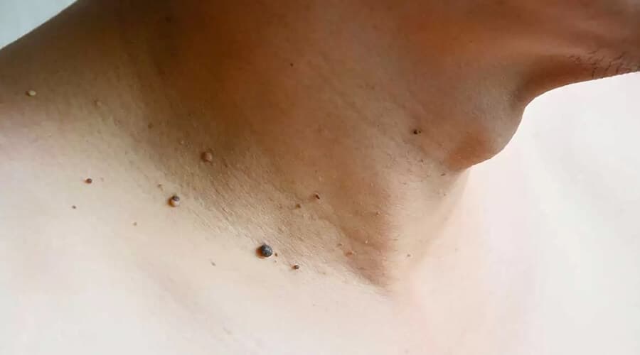 Fibromas Blandos (Verruga de cuello)