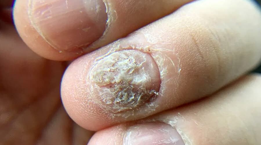 Hongos en la Piel y Uñas