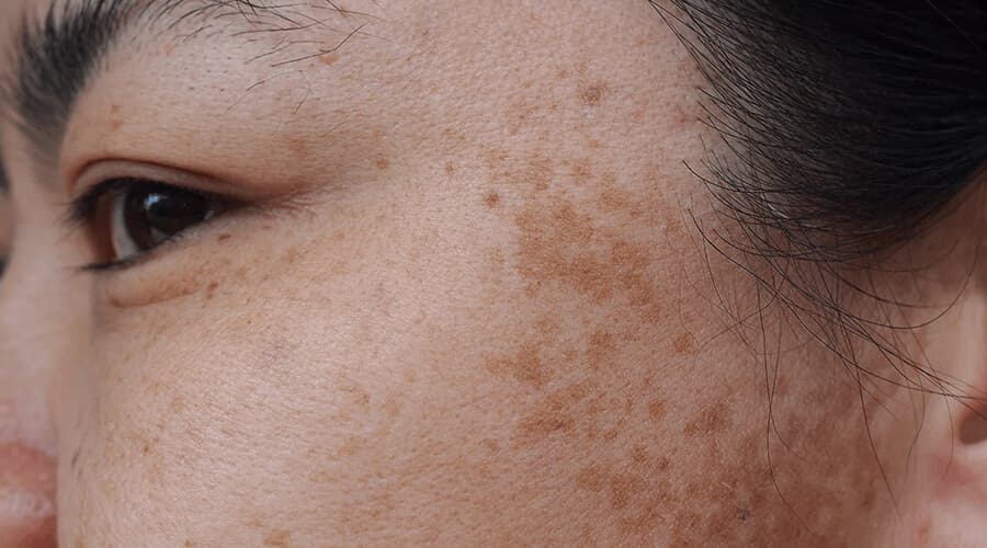 Melasma (manchas en la piel)