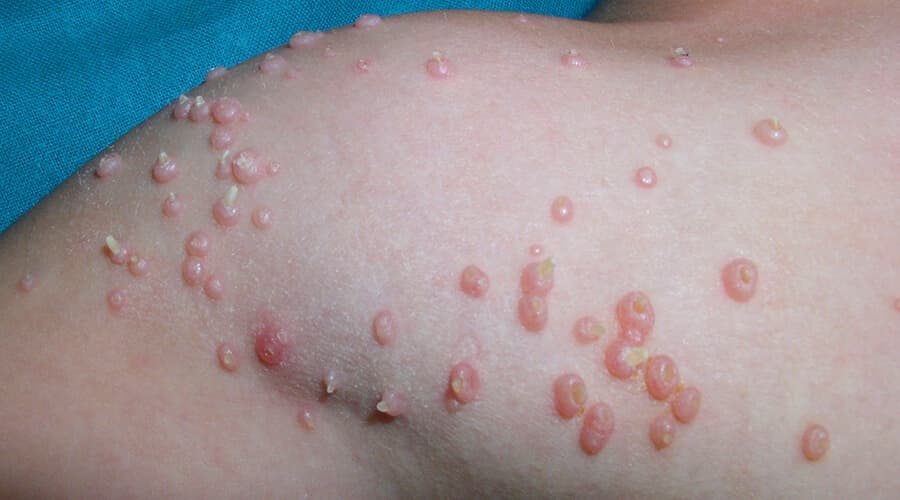 Molusco y Verrugas (VPH)