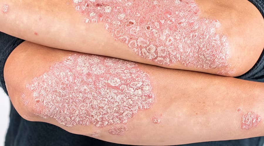 Psoriasis