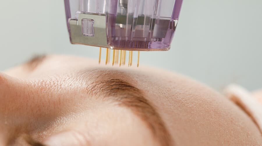 Aplicación de microneedling médico