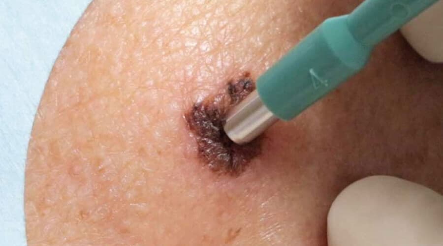 Biopsias de Piel (cáncer de piel)