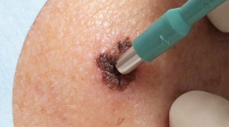 Biopsias de Piel (cáncer de piel)
