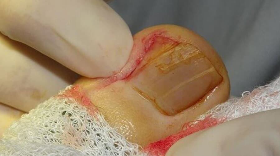 Cirugía de Uñas (uñas enterradas, tumores ungueales)