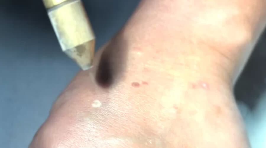 Crioterapia